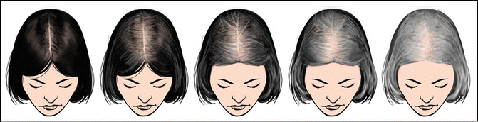 Ludwig scale female hair loss 