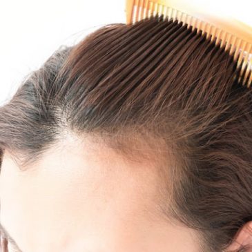 6 Main Causes of Hair Loss in Women