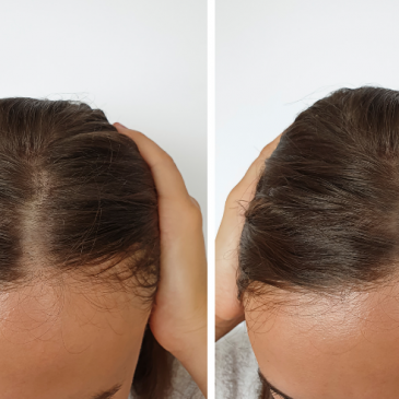 What Are The Best Reviewed Hair Loss Products for Women on the Market?