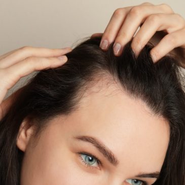 Receding Hairline in Women: Symptoms, Causes and Treatments