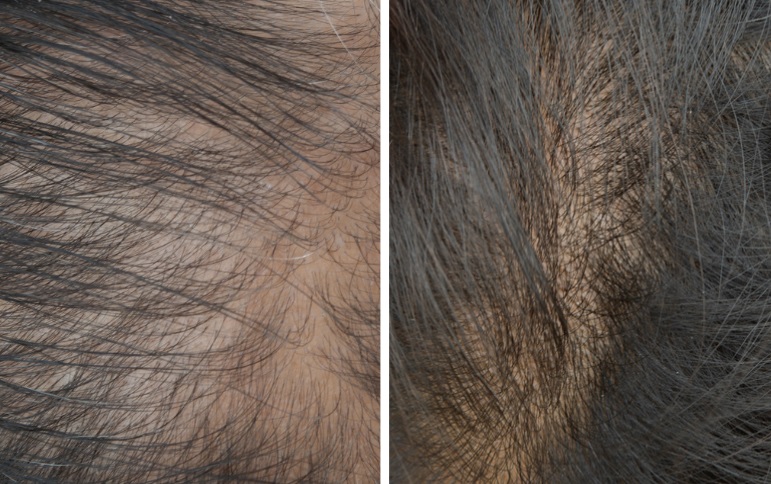 hair loss treatment for women before and after