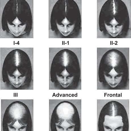 Savin scale measurements female hair loss 