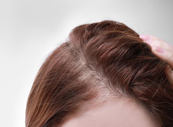 winter hair loss causes 