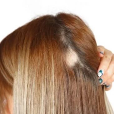 Traction Alopecia in Women: Causes, Symptoms, and Treatment Options