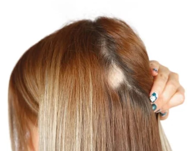 traction alopecia 