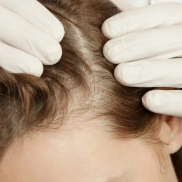 Women’s Hair Loss Explained: Causes, Symptoms & Treatments