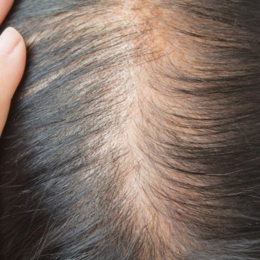 How To Treat Hair Loss Caused By Trauma